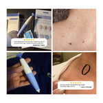 Auto Skin Tag Removal Kit. Shop Skin Care Tools on Mounteen. Worldwide shipping available.