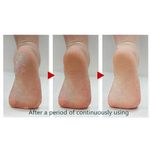 Professional Pedicure Callus Remover - Mounteen. Worldwide shipping available.
