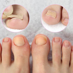 Toenail Corrector Patch (30 Pack). Shop Nail Care on Mounteen. Worldwide shipping available.
