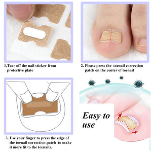 Toenail Corrector Patch (30 Pack). Shop Nail Care on Mounteen. Worldwide shipping available.