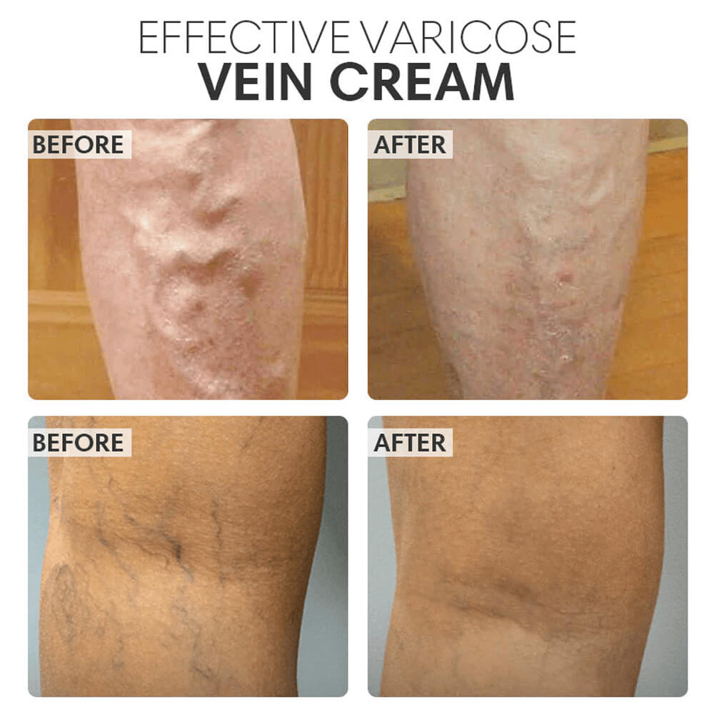 Vein Smoothing Varicose Veins Cream. Shop Skin Care on Mounteen. Worldwide shipping available.