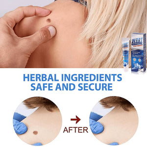 WartsOff Instant Blemish Removal Cream. Shop Wart Removers on Mounteen. Worldwide shipping available.